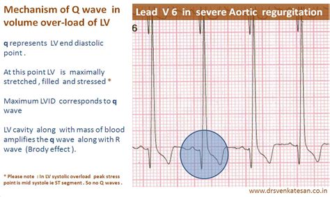 lv overload on ekg|left ventricular overload ecg.